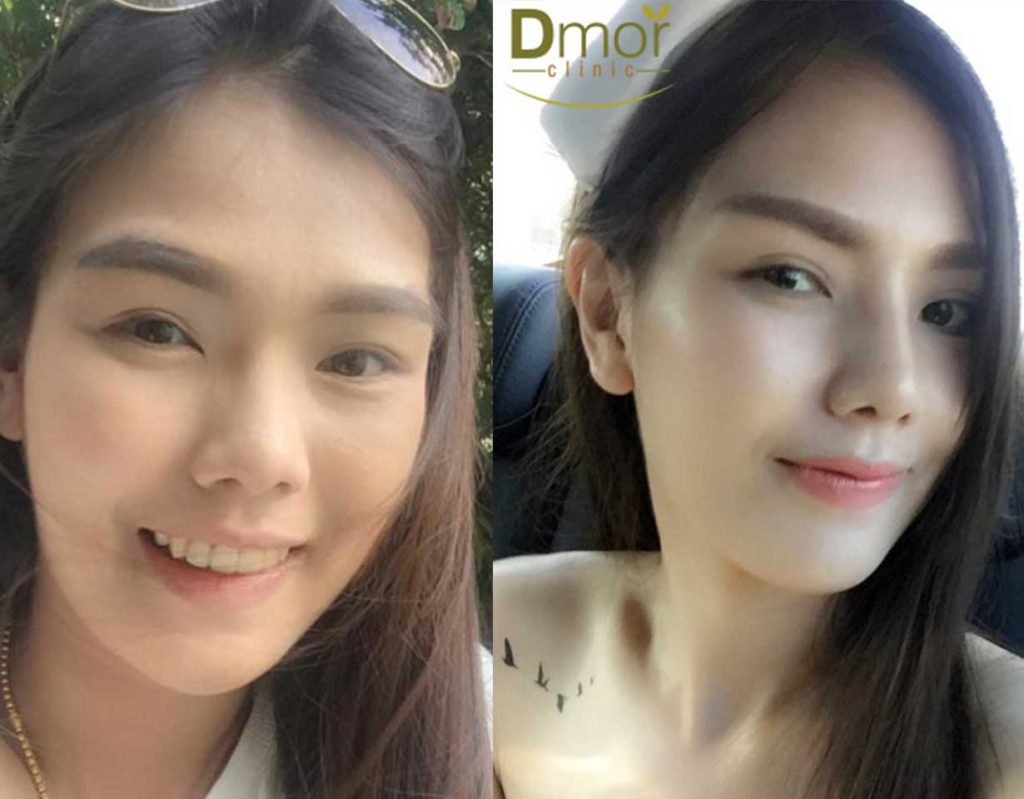 รีวิวการทำศัลยกรรมจมูกจากลูกค้า Dmor Clinic