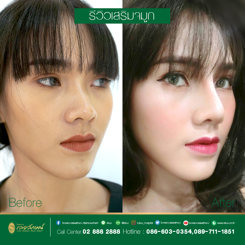 รีวิวการทำศัลยกรรมจมูกจากลูกค้า LeLux Clinic