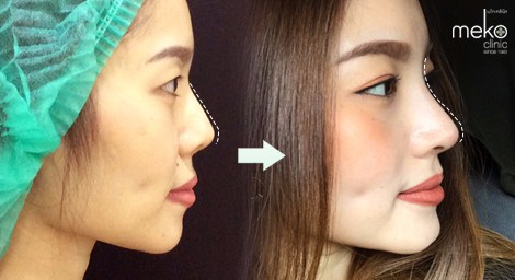 รีวิวการทำศัลยกรรมจมูกจากลูกค้า Meko Clinic - เมโกะ คลินิก