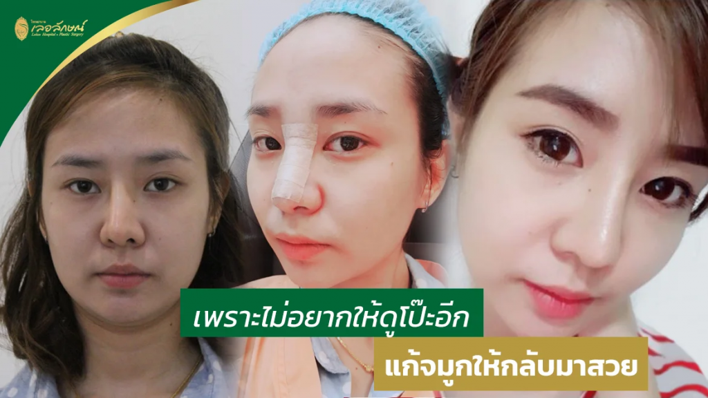 โรงพยาบาลเลอลักษณ์ ตัดปีกจมูก - 1