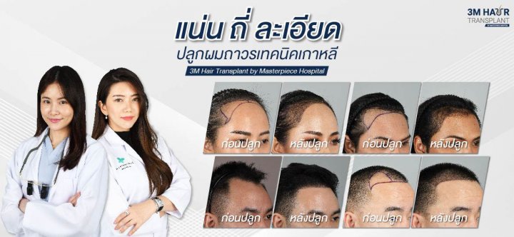 3M Hair Transplant By Masterpiece Hospital ปลูกคิ้วถาวร - 1