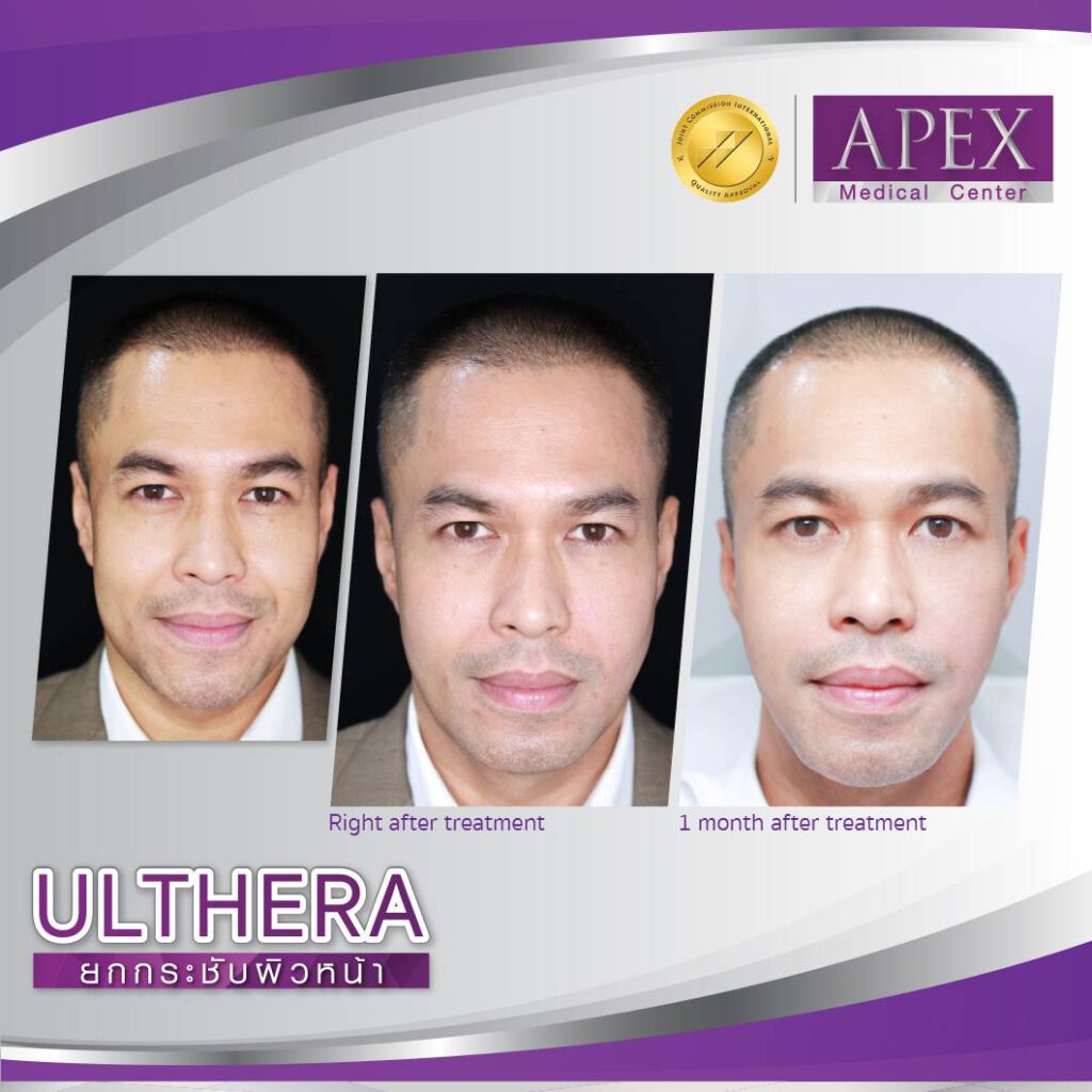 APEX Clinic บริการทำ Ulthera - 2