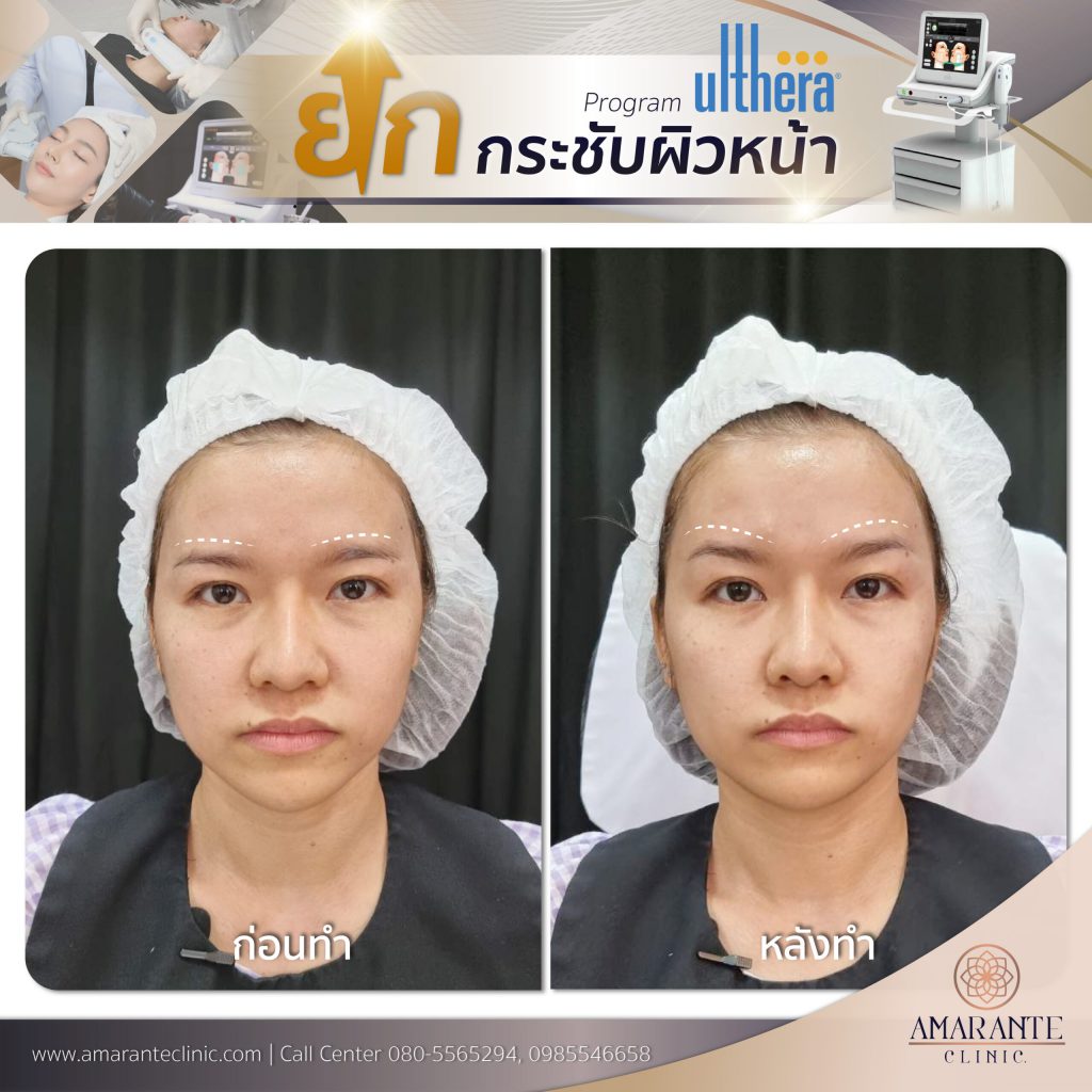 Amarante Clinic คลินิกทำ Ulthera - 2