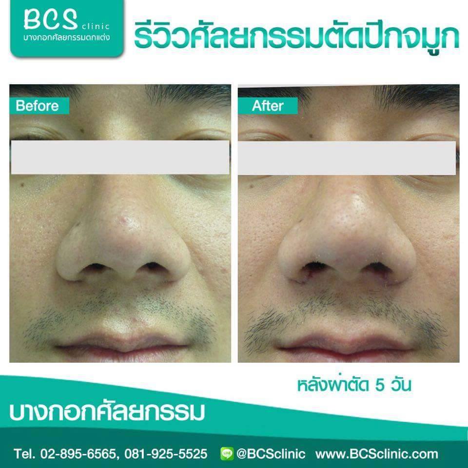 BCS Clinic บริการตัดปีกจมูก - 2