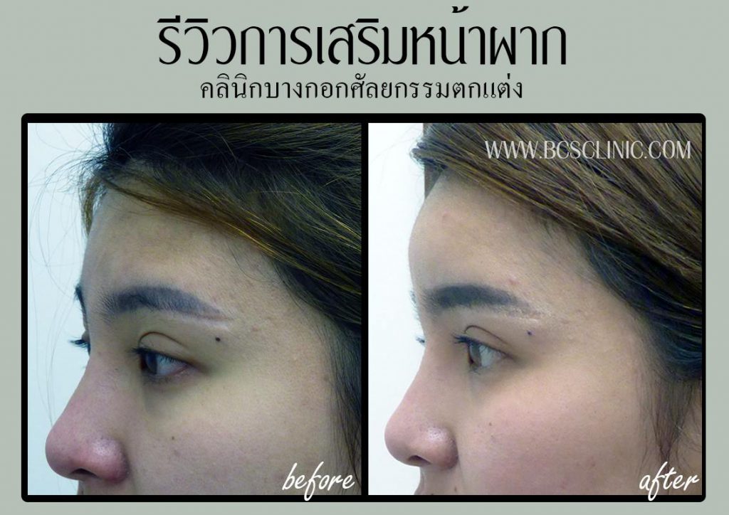 BCS Clinic เสริมหน้าผากซิลิโคนที่ดีที่สุด - 2