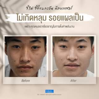 BSL Clinic โปรแกรมจี้ไฝ - 2