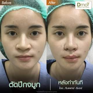 Dmor Clinic คลินิกตัดปีกจมูก - 2