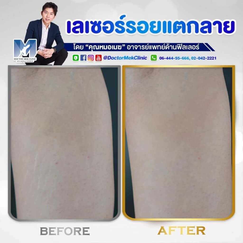 Doctor Mek Clinic บริการเลเซอร์รอยแตกลาย - 2