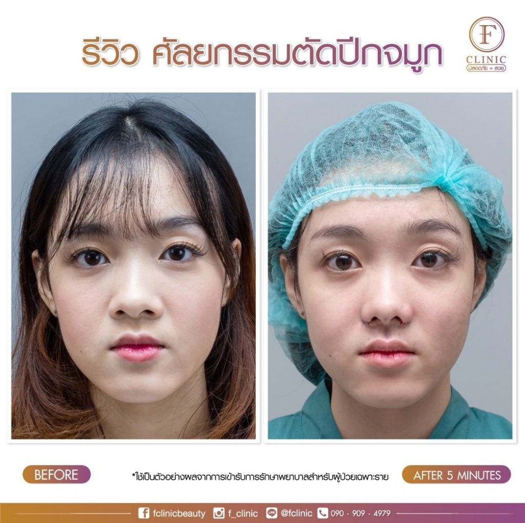 F Clinic ศัลยกรรมตัดปีกจมูก - 2