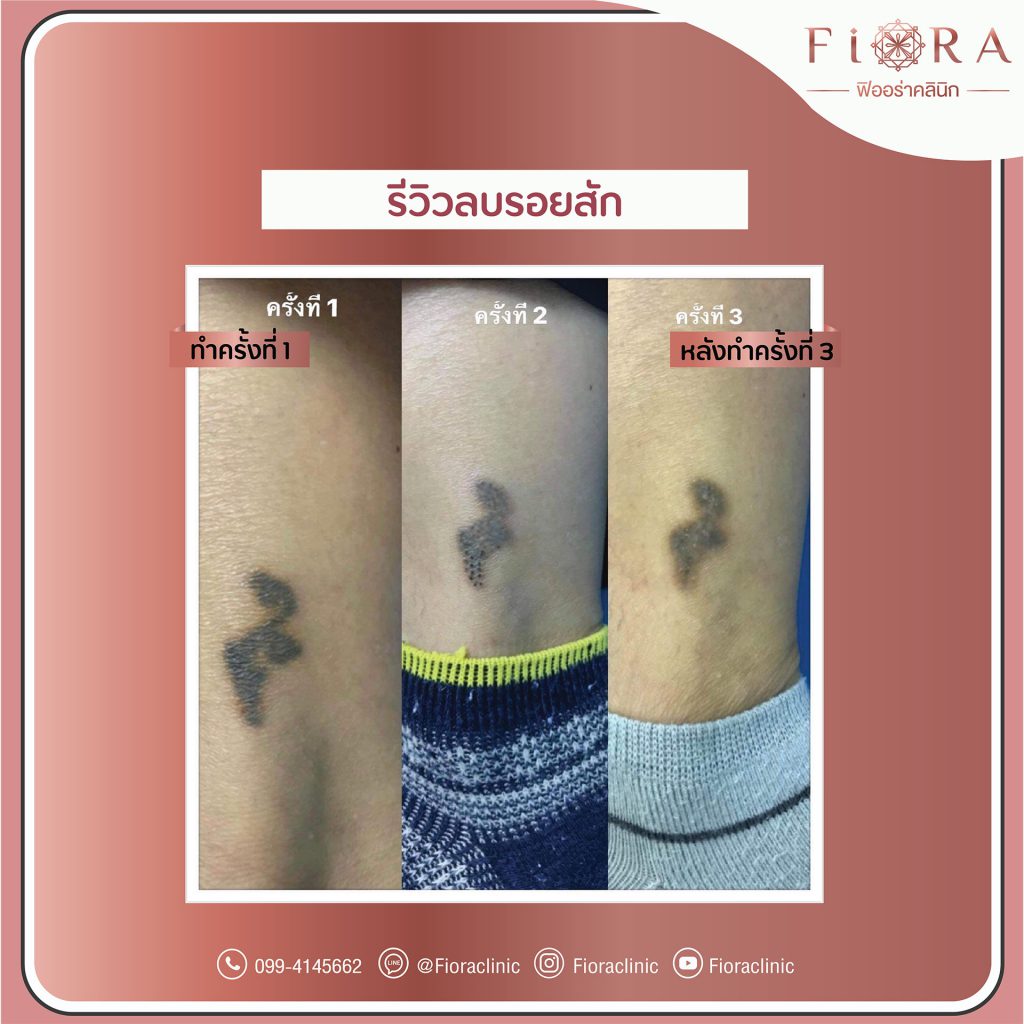 Fiora Clinic คลินิกลบรอยสัก - 2