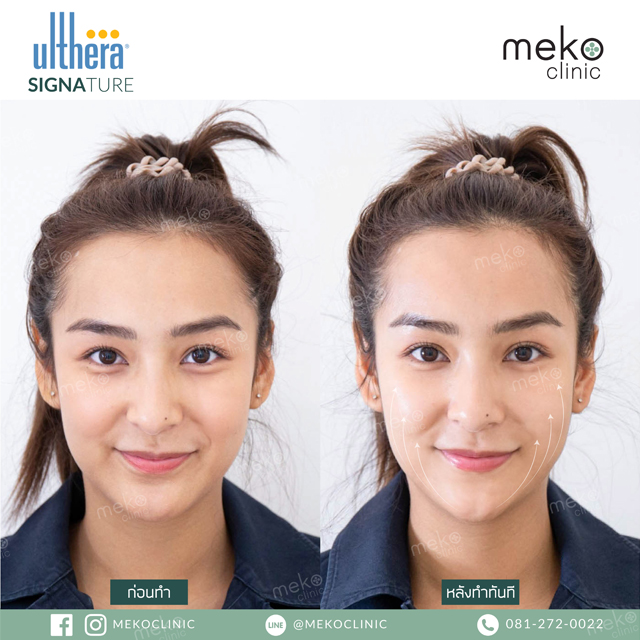 Meko Clinic คลินิกทำ Ulthera - 2