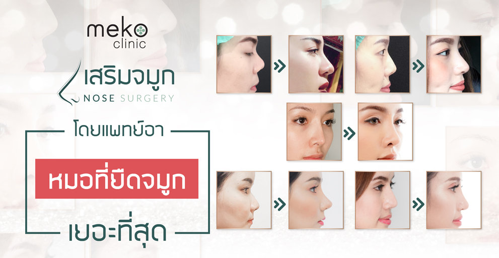 Meko Clinic ศัลยกรรมจมูกผู้ชาย - 1