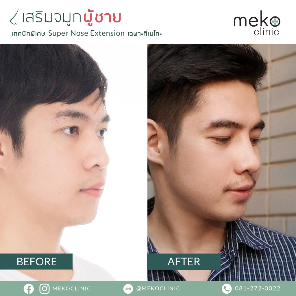 Meko Clinic ศัลยกรรมจมูกผู้ชาย - 2