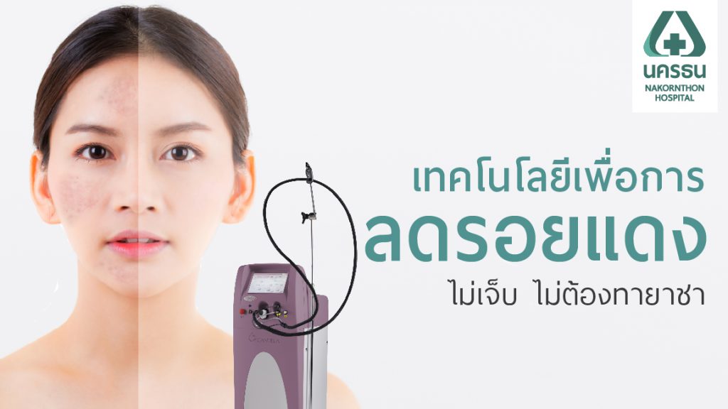 Nakornthon Hospital เลเซอร์ Vbeam - 1