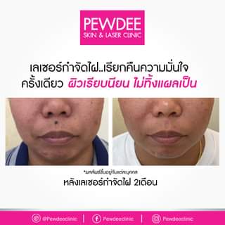 Pewdee Clinic คลินิกจี้ไฝ - 2