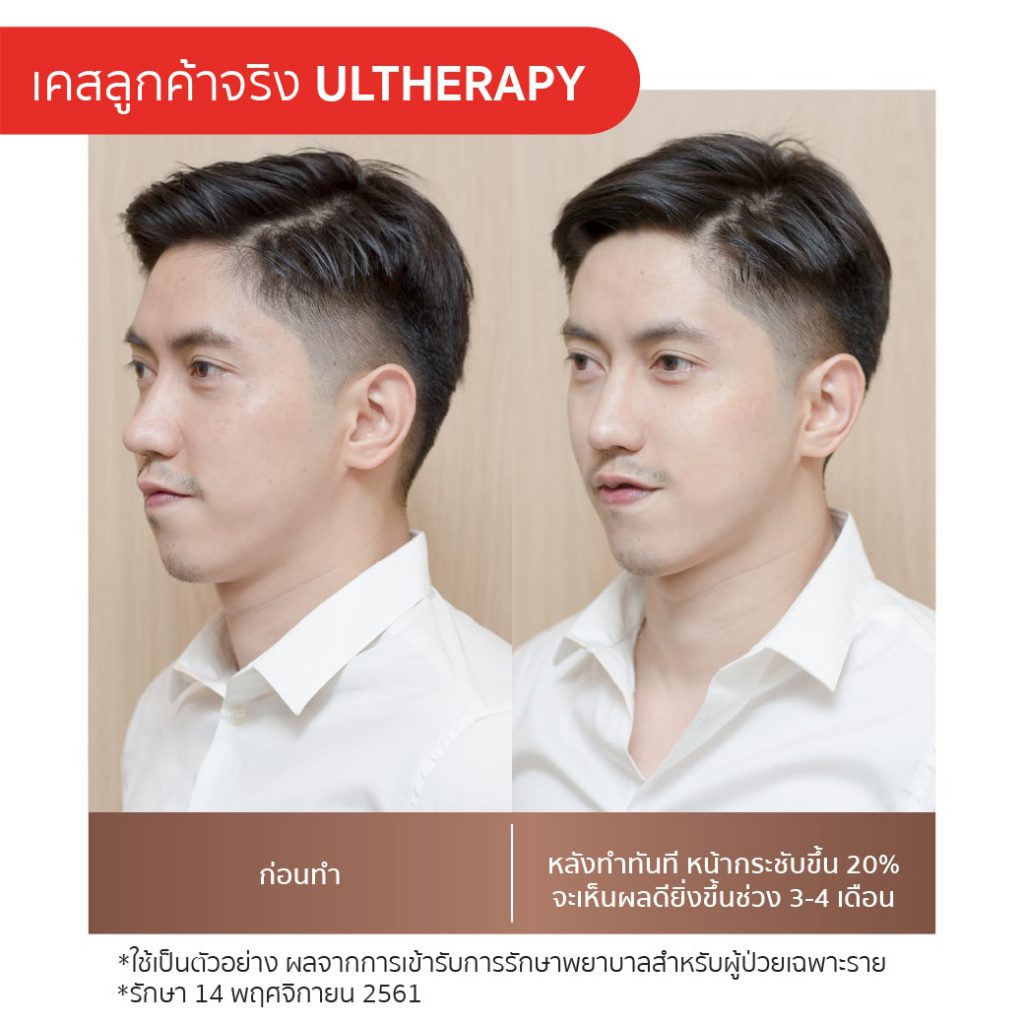 Pongsak Clinic บริการทำ Ulthera - 2