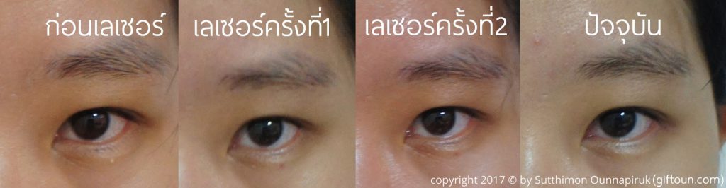 Pornkaserm Clinic เลเซอร์สิวหิน - 2