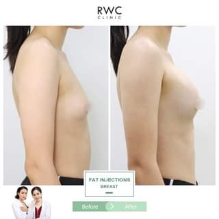 RWC Clinic ฉีดไขมันหน้าอก - 2