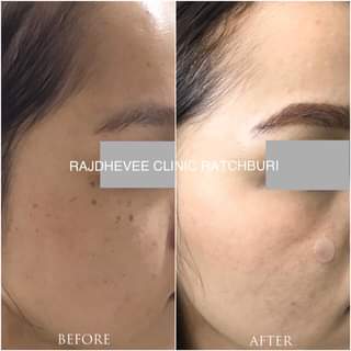 Rajdhevee Clinic บริการเลเซอร์สิวหิน - 2