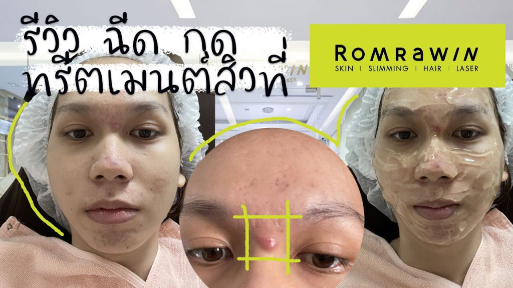 Romrawin Clinic คลินิกกดสิว - 2