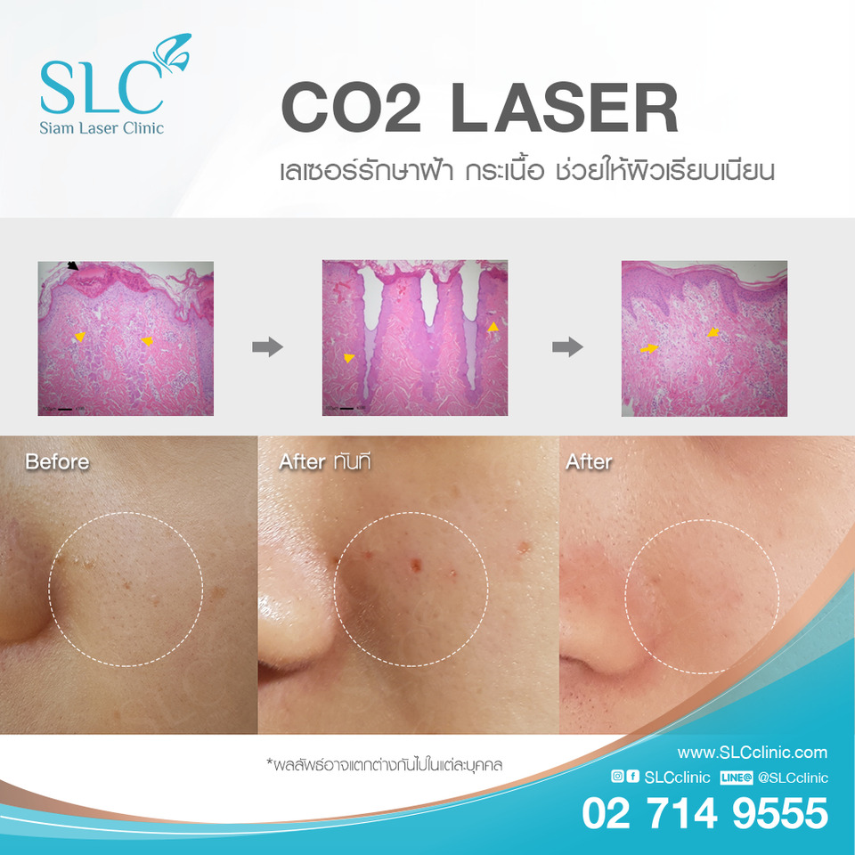 SLC Clinic เลเซอร์สิวหิน - 2