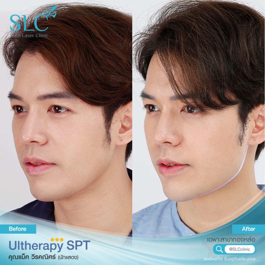 SLC Clinic โปรแกรมทำ Ulthera - 2