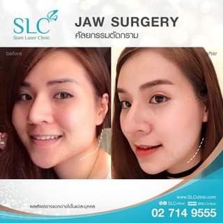 SLC Clinic โปรแกรมผ่าตัดกราม - 2