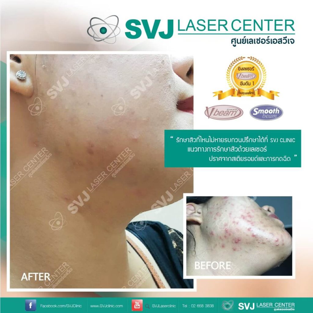 SVJ Laser Center บริการเลเซอร์ Vbeam -2