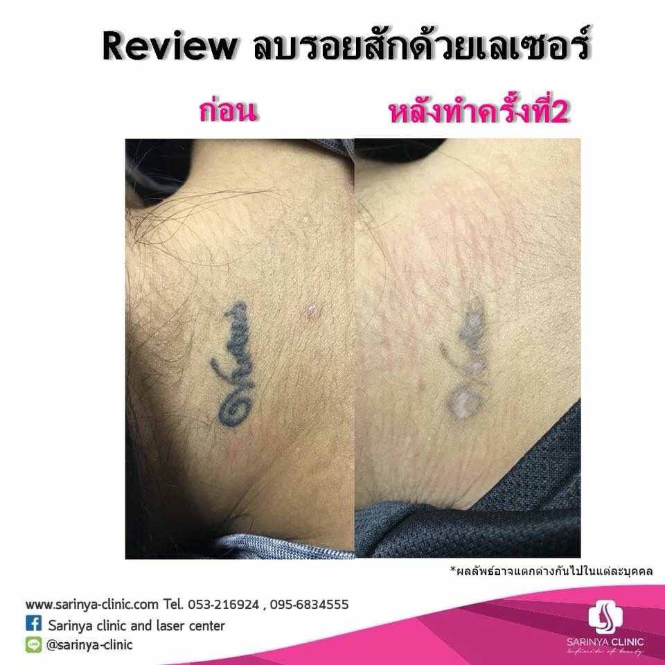 Sarinya Clinic บริการลบรอยสัก - 2