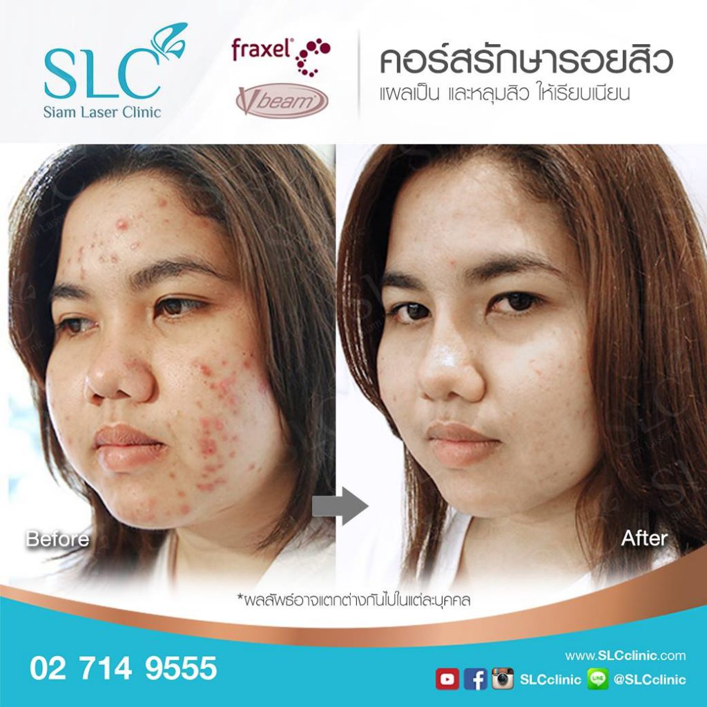 Siam Laser Clinic คลินิกเลเซอร์ Vbeam - 2