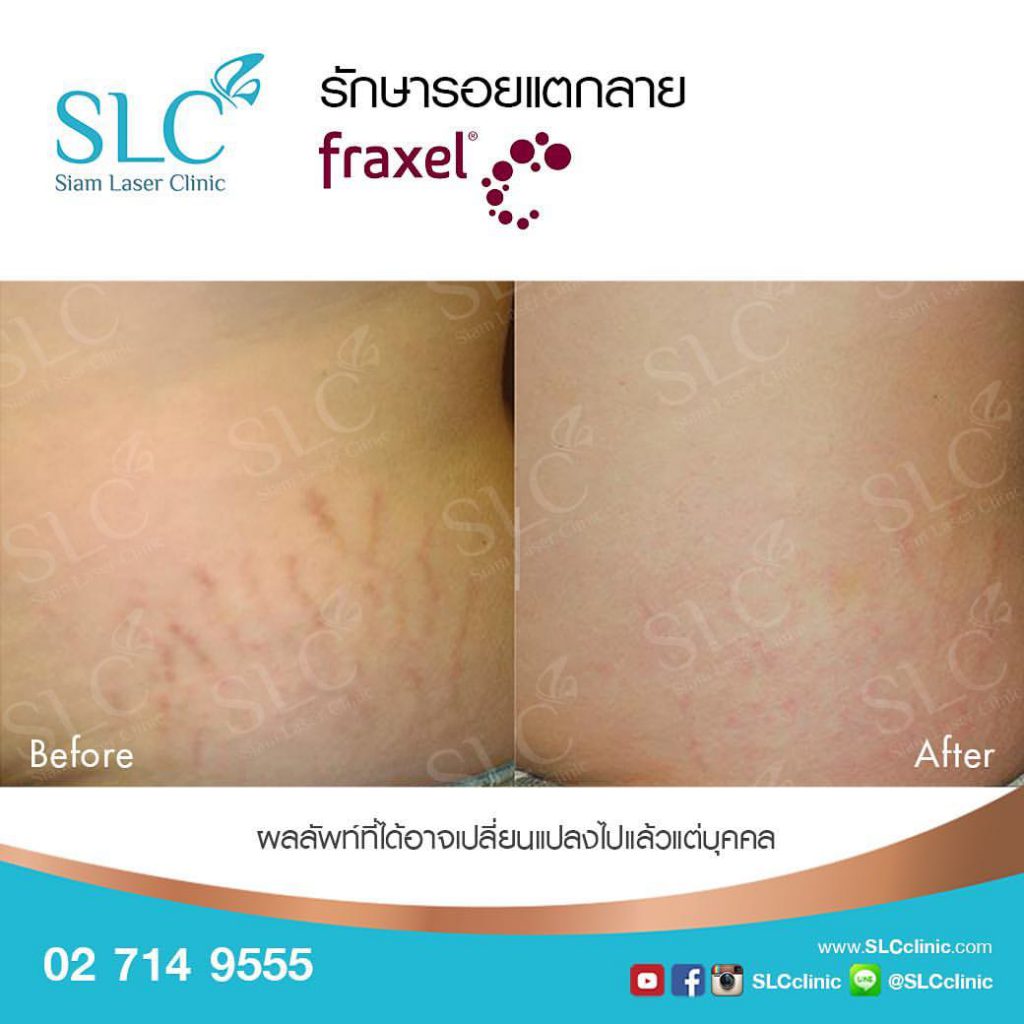 Siam Laser Clinic เลเซอร์รอยแตกลาย - 2