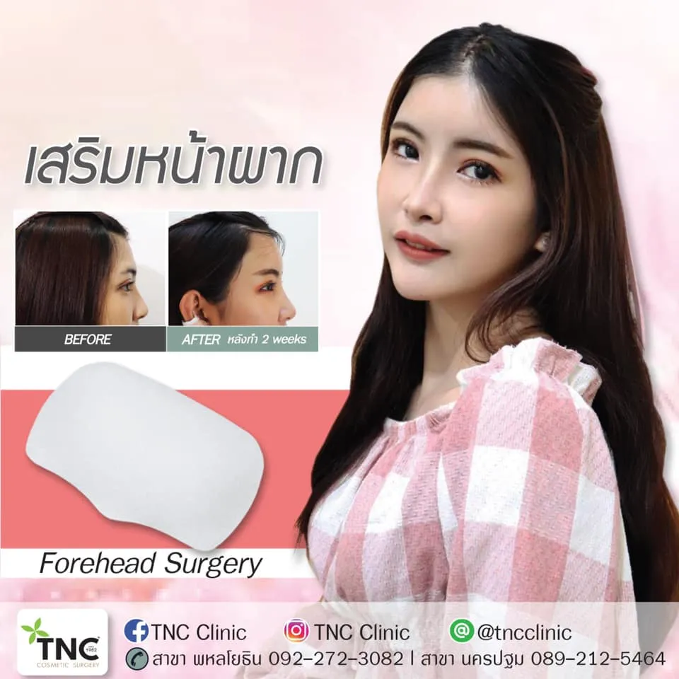 TNC Clinic เสริมหน้าผากซิลิโคน - 2