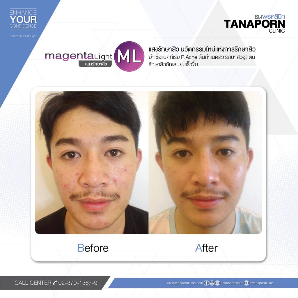 Tanaporn Clinic บริการเลเซอร์สิวหินที่ดีที่สุด - 2