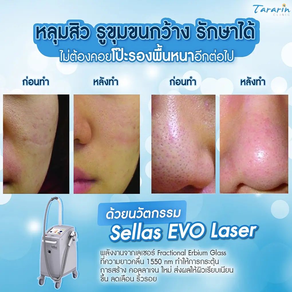 Tararin Clinic เลเซอร์สิวหินที่ดีที่สุด - 2