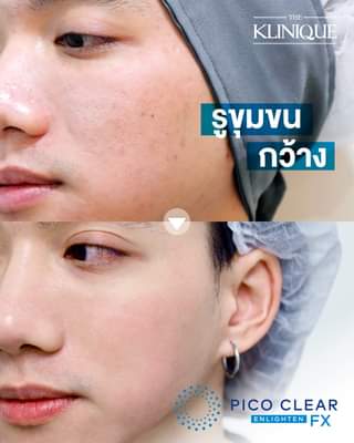 The Klinique บริการเลเซอร์จุดด่างดำ - 2