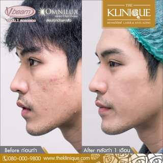 The Klinique เลเซอร์ Vbeam - 2