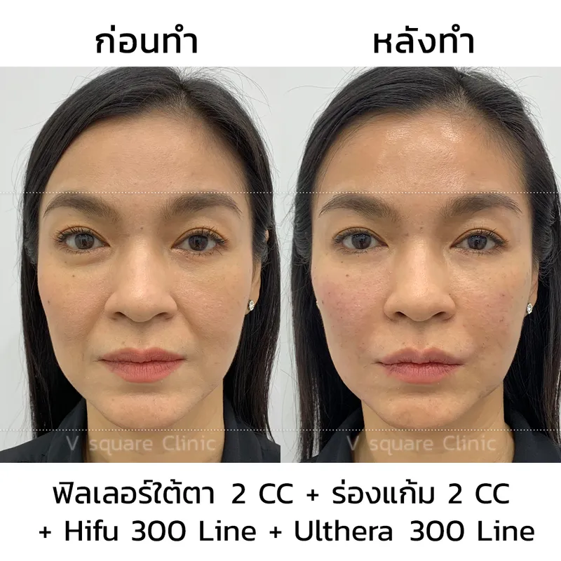 V Square Clinic Ulthera ที่ดีที่สุด - 2