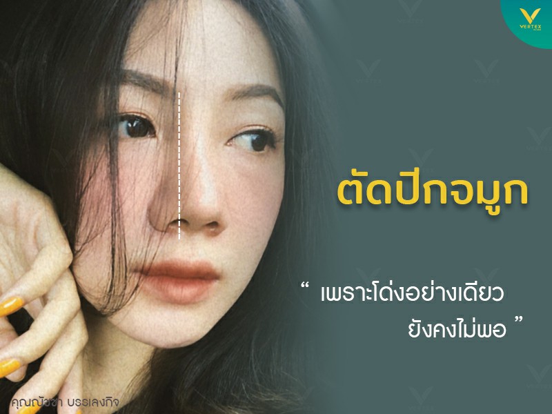 Vertex Clinic บริการตัดปีกจมูก - 1