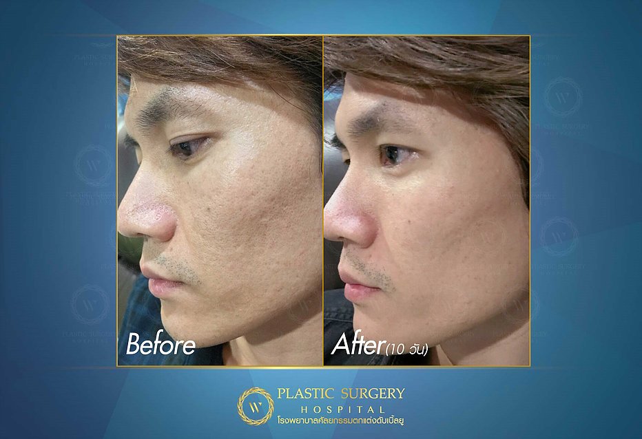 W Plastic Surgery Hospital เลเซอร์สิวหิน - 2