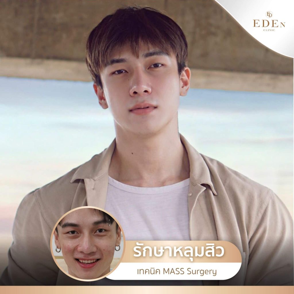 รีวิว รักษาหลุมสิว กับ E-DEn clinic