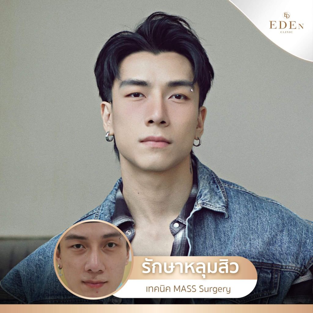 รีวิว รักษาหลุมสิว กับ E-DEn clinic