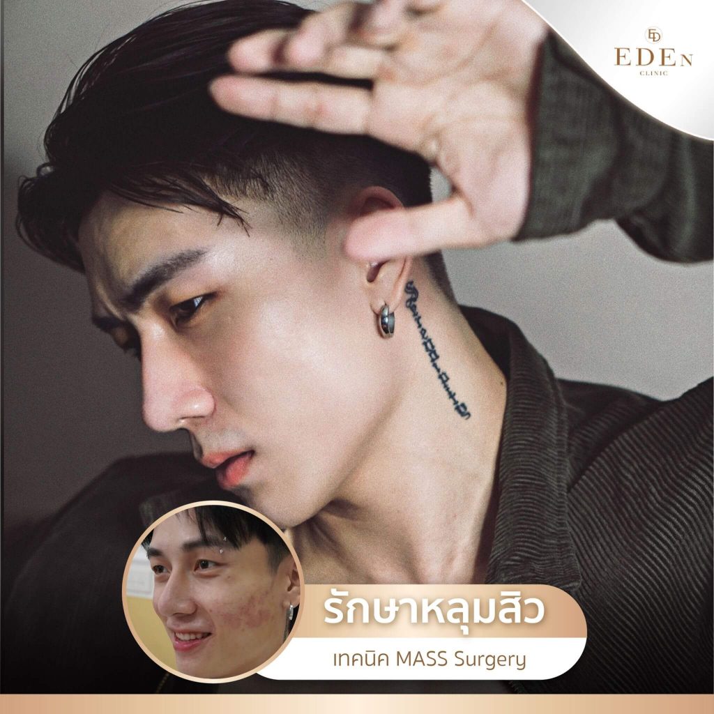 รีวิว รักษาหลุมสิว กับ E-DEn clinic