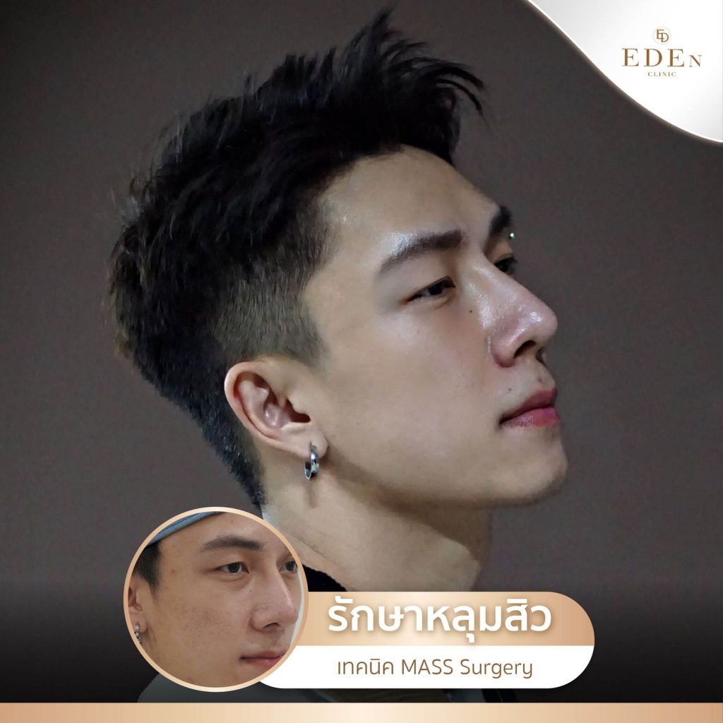 รีวิว รักษาหลุมสิว กับ E-DEn clinic