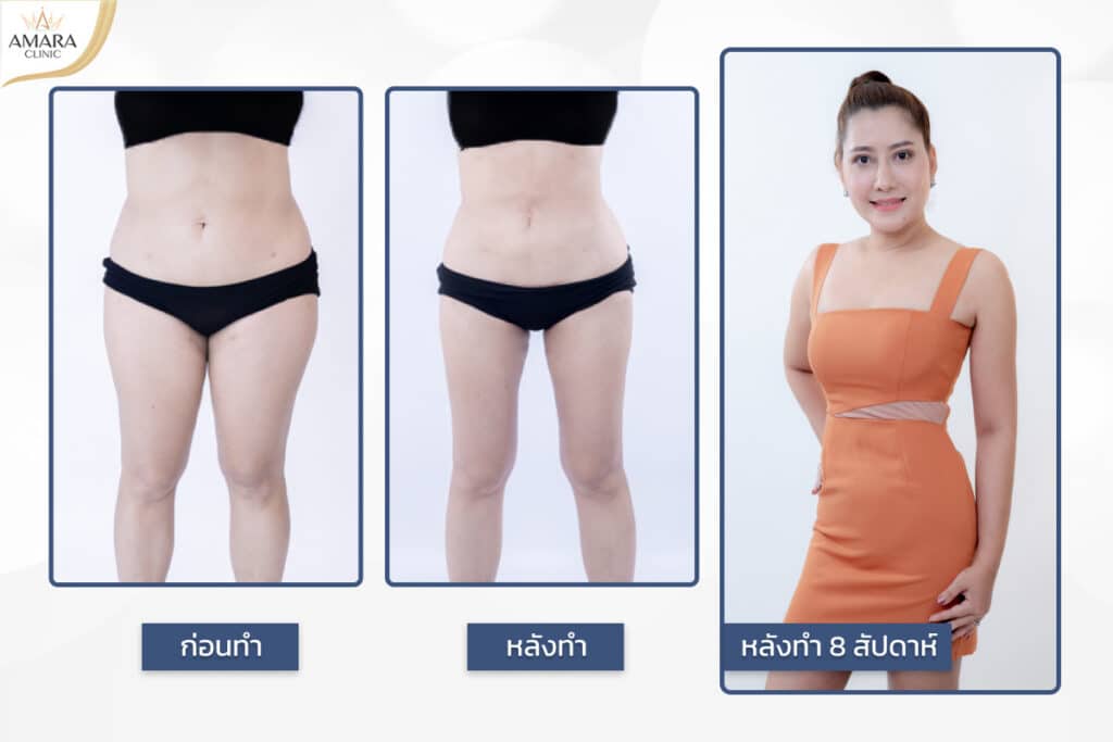 Amara Clinic คลินิกดูดไขมัน - 2