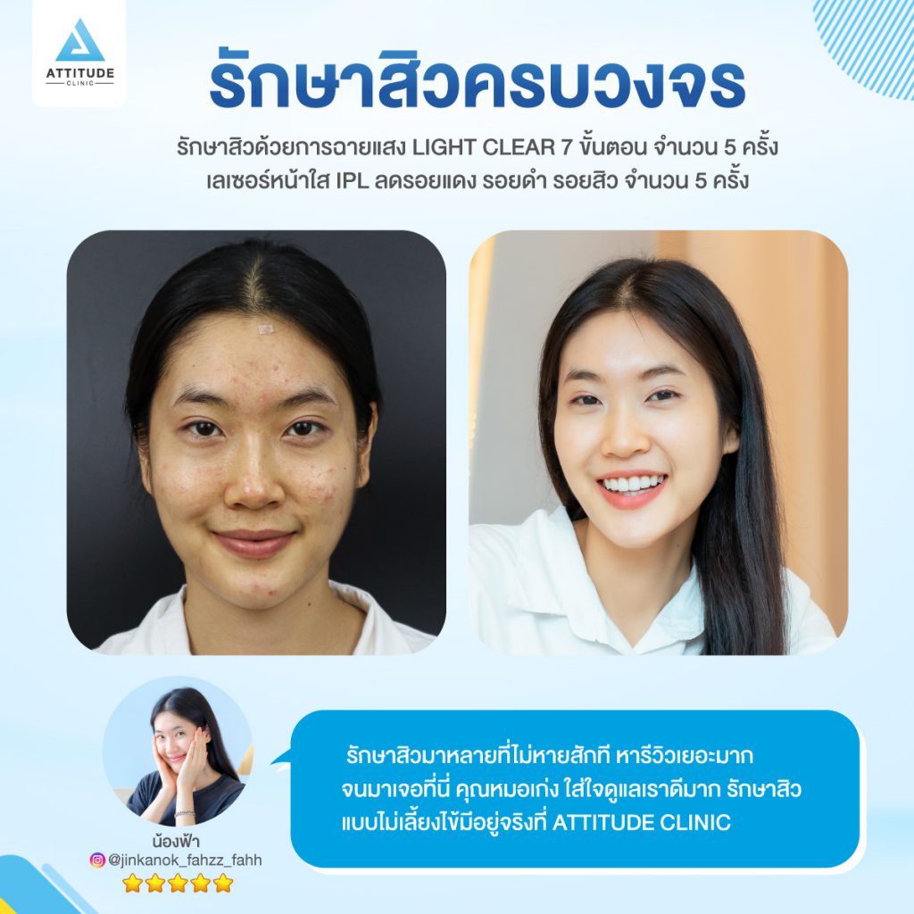 Attitude Clinic คลินิกกดสิว เชียงใหม่ - 2