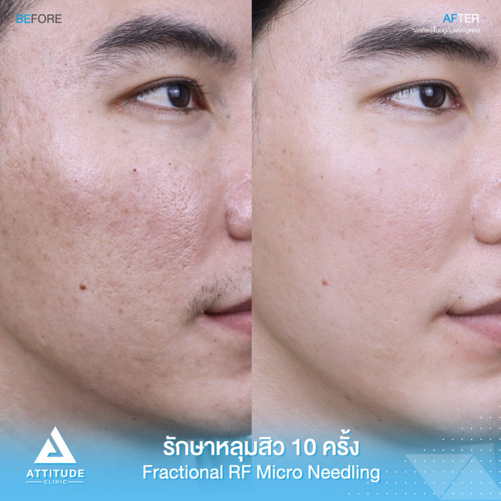 Attitude Clinic คลินิกตัดพังผืดหลุมสิว เชียงใหม่ - 2