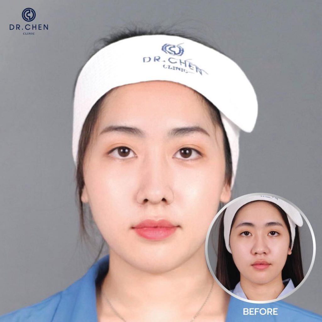 Dr.Chen Clinic บริการทำจมูก เชียงใหม่ - 2