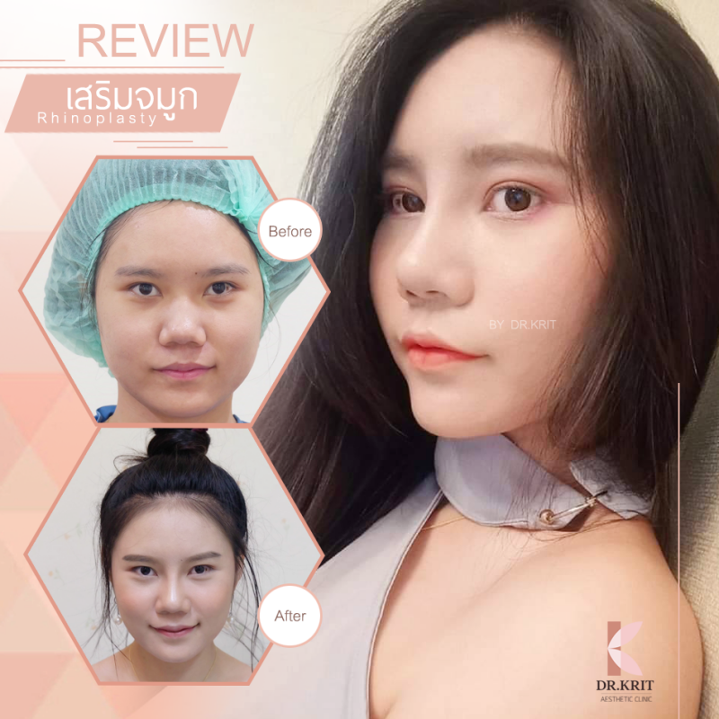 Dr.Krit Clinic บริการทำจมูก เชียงใหม่ - 2