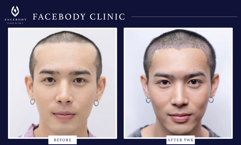 FACEBODY Clinic by Dr. T คลินิกปลูกผม - 2