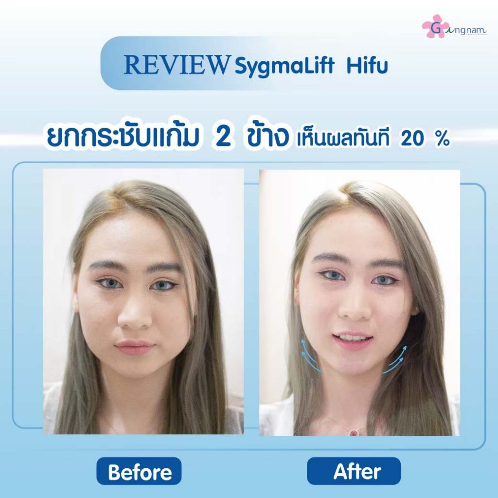 Gangnam Clinic บริการทำ Hifu - 2